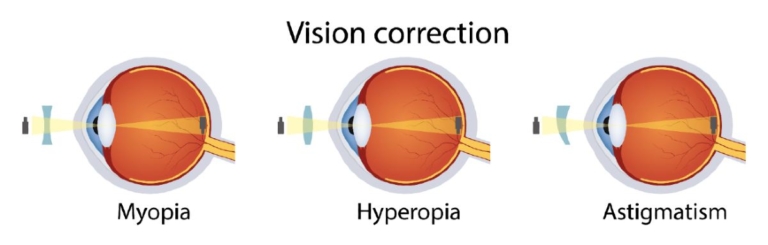 Myopia: What it is, and How to Correct it | BDP Vision Correction