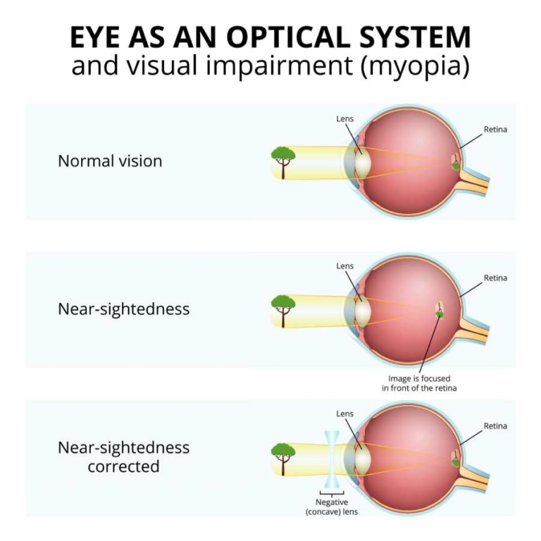 myopia-what-it-is-and-how-to-correct-it-bdp-lasik